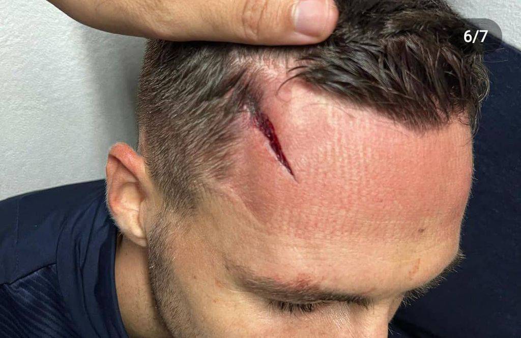 Hajdukov stoper pokazao kako mu izgleda glava nakon sudara: Zadobio užasnu posjekotinu