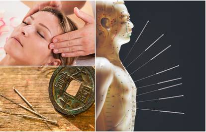 Akupunktura: Ugodno bockanje iglama budi vitalnu energiju