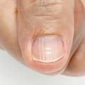 Što znače bijele mrlje i ostale promjene na noktima: Nekad je dovoljno promijeniti prehranu