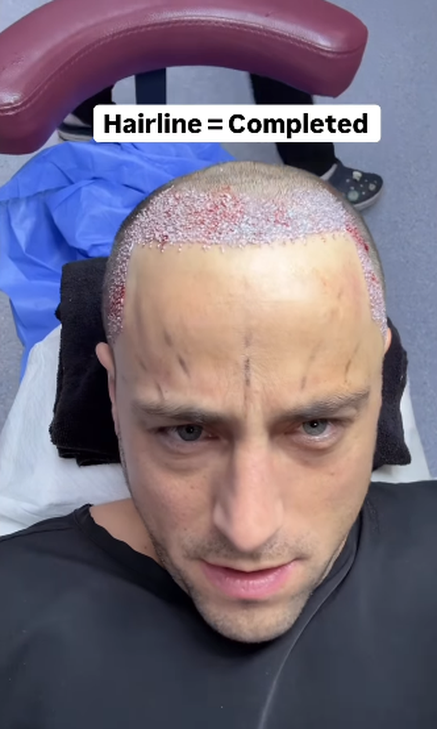 Trojčeki otputovali u Tursku na transplantaciju kose: 'Ne može samo jedan imati dobru frizuru'