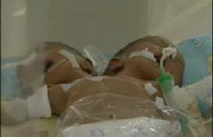 Indonezija: Rodila sijamske blizance sa jednim tijelom
