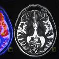 Otkriven novi oblik demencije - simptomi su slični Alzheimeru