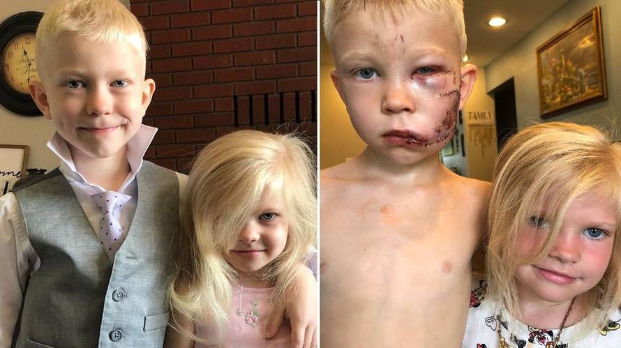Dječak (6) spasio mlađu sestru od ugriza psa: Dobio 90 šavova