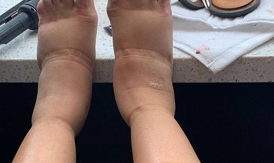 Liposukcija Cardi B nije prošla dobro: Ma, nikada više pod nož!