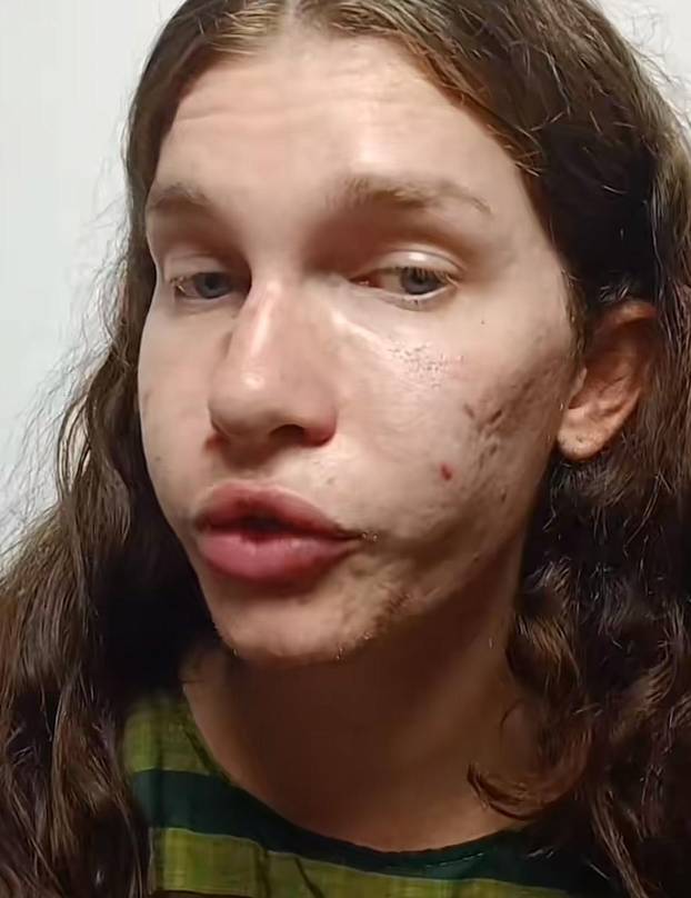 FOTO Htjela je biti žena mačka, a sad plače: Dala sam 7000 €, a fileri su me unakazili! Pomiču se