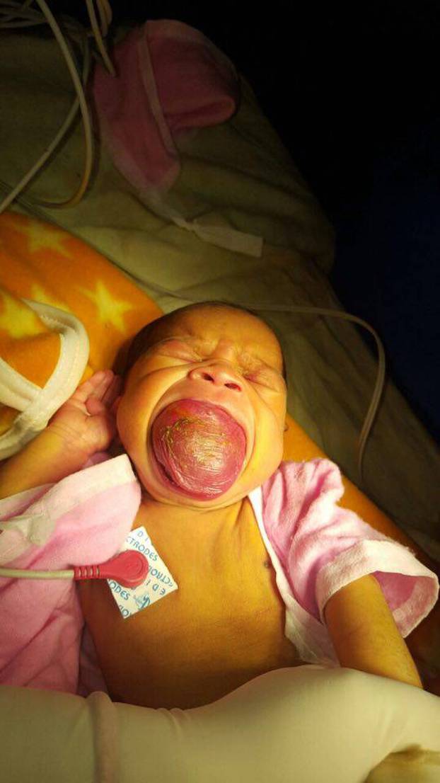 Exclusive Baby can smile after docs cut to size his giant tongue that was choking on him