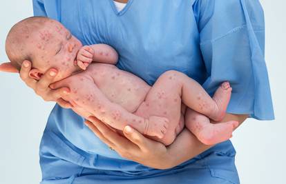 Majčin imunitet štiti bebe od ospica samo prva tri mjeseca
