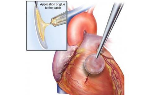 Napravili su novo "pametno ljepilo" za operacije na srcu