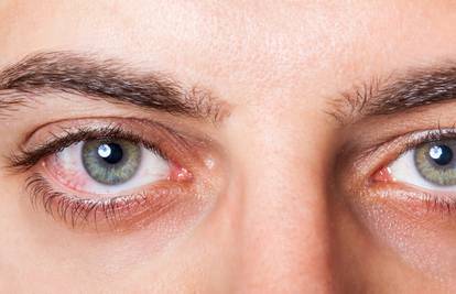 S.O.S. kod ozljede oka: Evo što treba učiniti u svakom slučaju