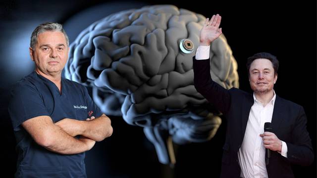 Čovjeku ugradili čip u mozak: 'Velik je ovo napredak, pomaže probuditi uspavani dio tijela'