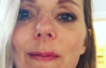 Krvarila iz nosa i s usana: Geri Horner je lice 'uništila' mačka