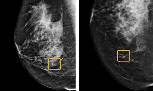 Novi program bolji u dijagnozi raka dojke od samih radiologa