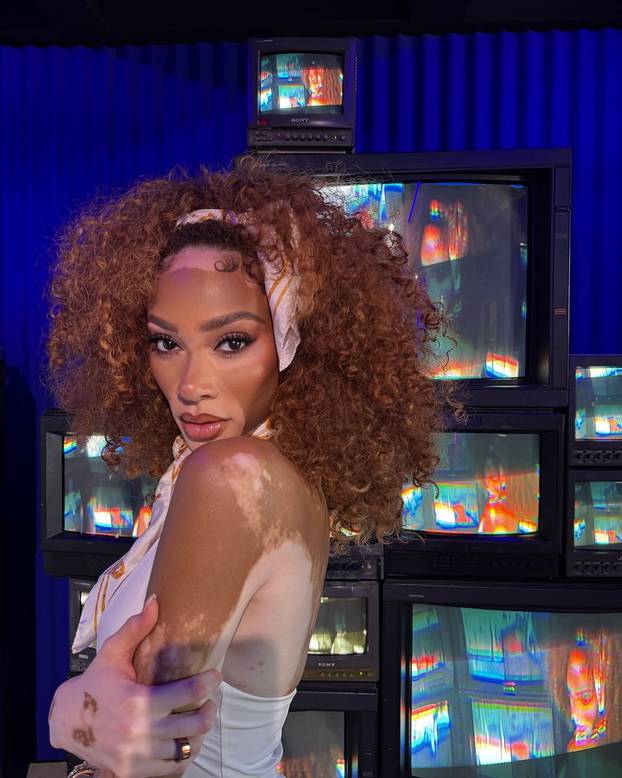 FOTO Rugali su joj se zbog bolesti, a danas je obožavaju zbog jedinstvenog izgleda