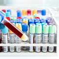 Australski istraživači izumili 20-minutni test krvi na koronavirus