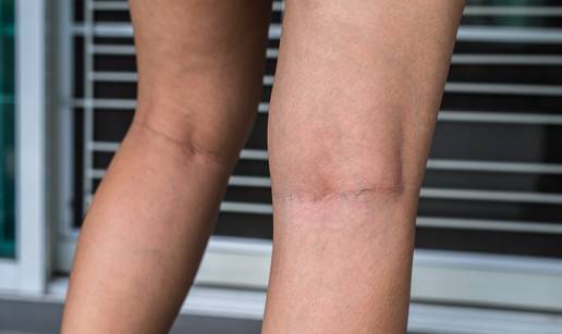 Imate proširene vene? Ovo su stvari na koje morate pripaziti