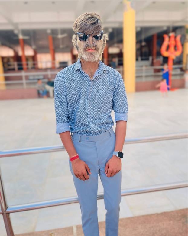 FOTO Ovaj mladić (18) pati od sindroma vukodlaka: U školi me sprdaju, ali volim svoje dlake...