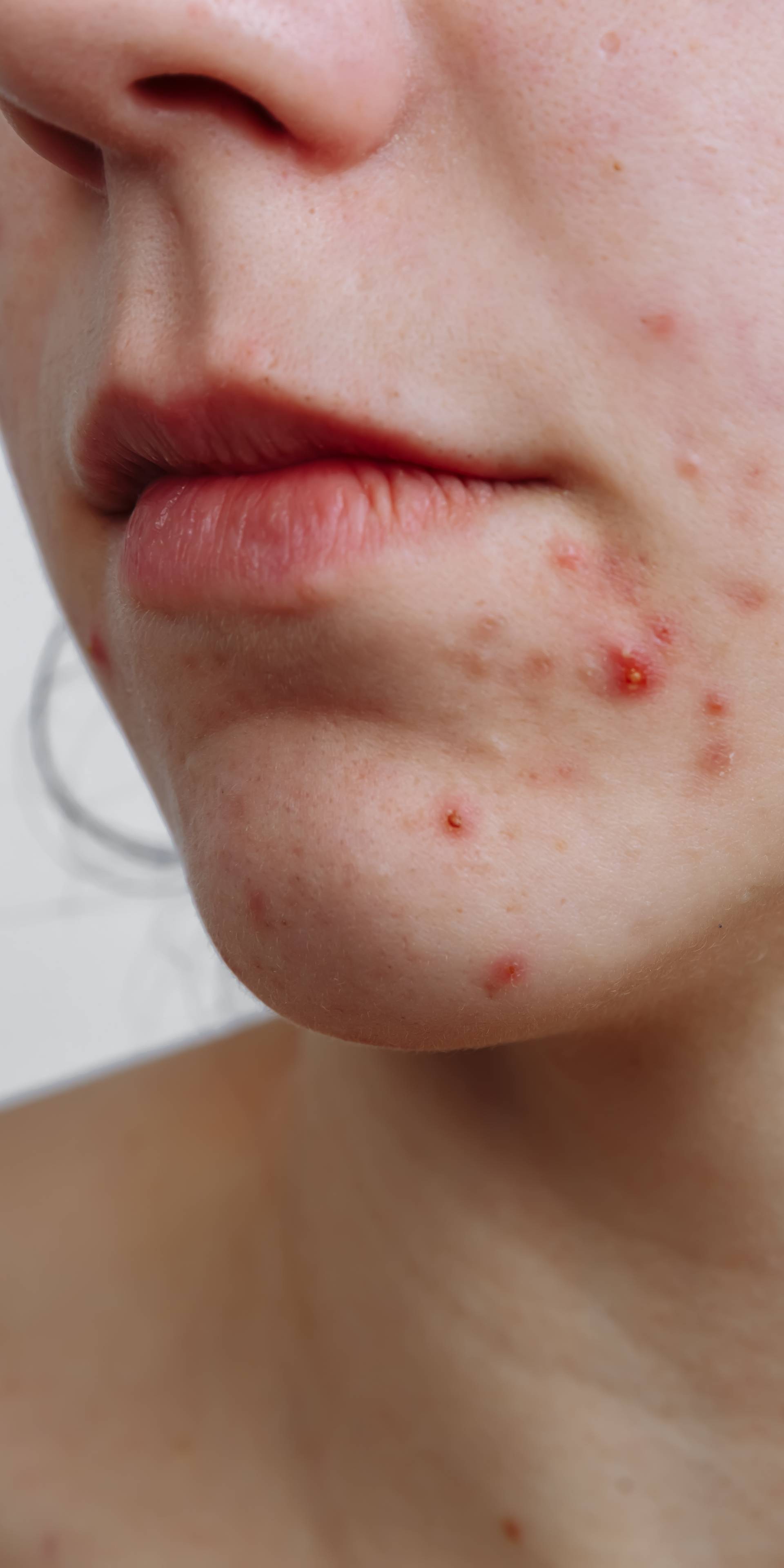 Uporne akne: Gdje sve na licu izbijaju i kako ih treba liječiti