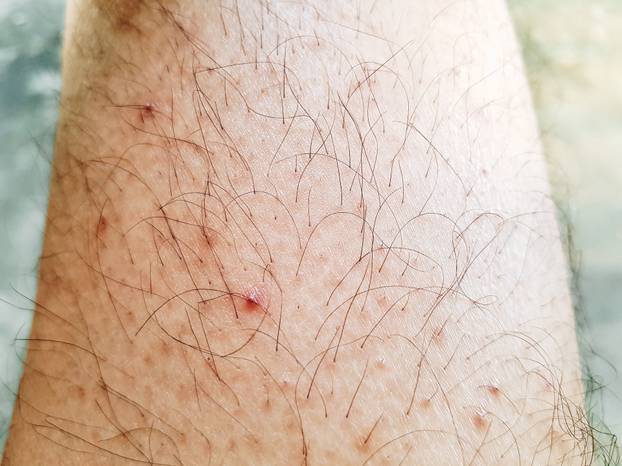 Kvržica, madež ili neka druga promjena na koži? Ovo su znakovi da trebate liječniku