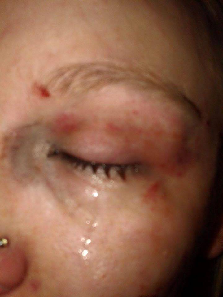 Sestre žrtve napada: 'Mislila sam da će mi iskopati oko'