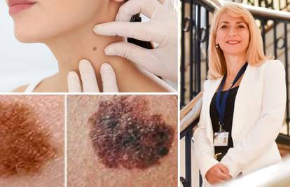 Sve o raku kože: Što povećava rizik od melanoma i koji ljudi moraju biti posebno oprezni
