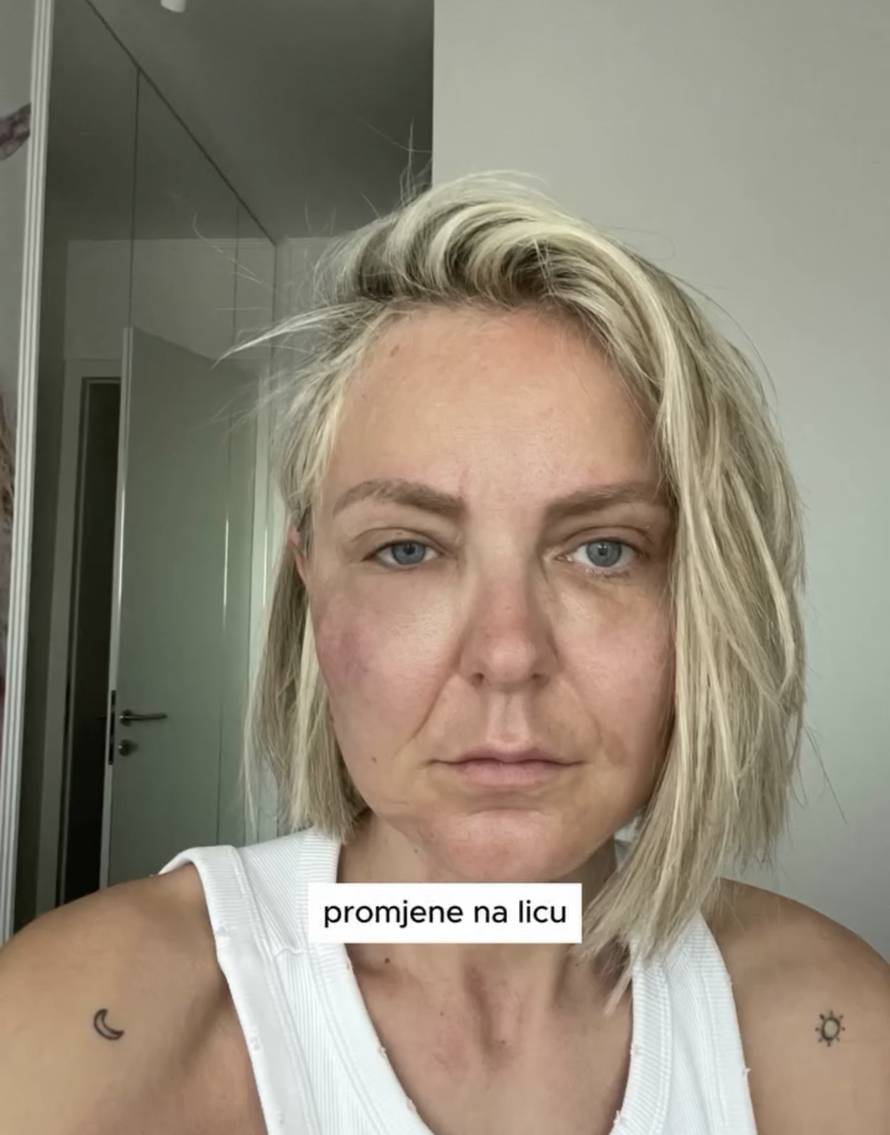 Stankica iz 'Savršenog' nakon traume zbog filera napravila neočekivani životni zaokret...