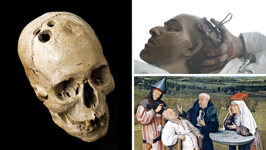 Jezivi zahvati: Zašto su preci Hrvata bušili lubanje na živo?!