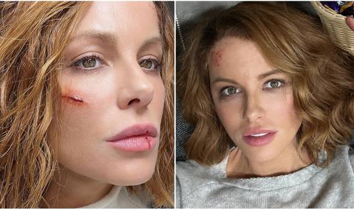 Vizažistica Tatjana o povredama Kate Beckinsale: 'Ozljede nisu stvarne, ja sam ju našminkala'