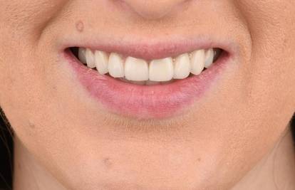 Kako izgleda proces ugradnje dentalnih ljuskica?