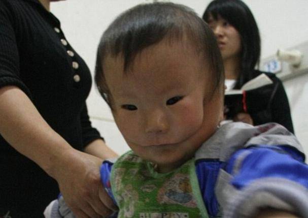 Ima rascjep preko lica: Kineza su prozvali 'dječak s maskom'