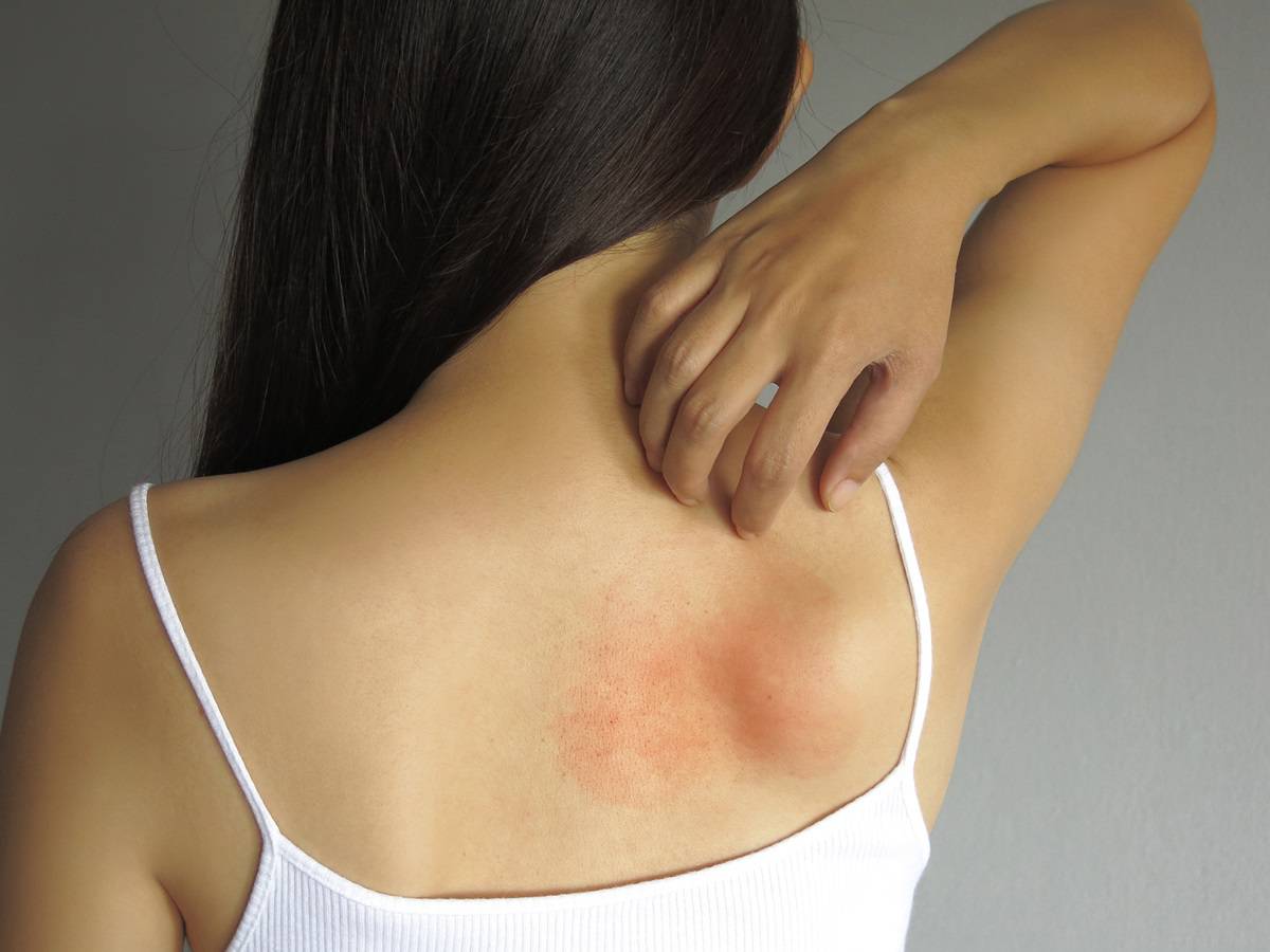 Health,Allergy,Skin,Care,Problem.,Closeup,Young,Woman,Scratching,Her