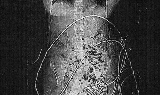 'Pucao sam slučajno': U ženi završilo  100 metalnih kuglica