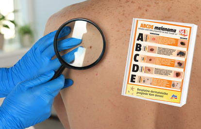 Potražite besplatan plakat o melanomu u srijedu uz 24sata