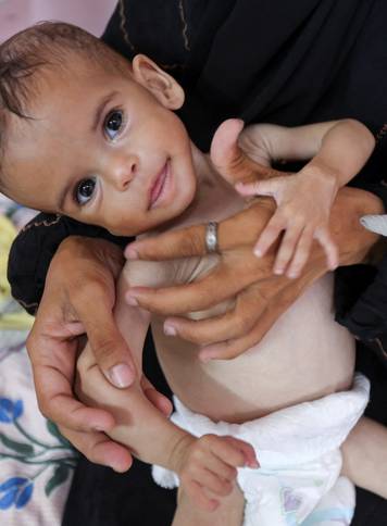 Malnourished Palestinian girl Seela Barbakh receives treatment at Nasser Hospital in Khan Younis, in the southern Gaza Strip