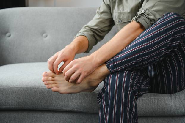 Man's legs have symptoms Itchy feet caused by fungi.
