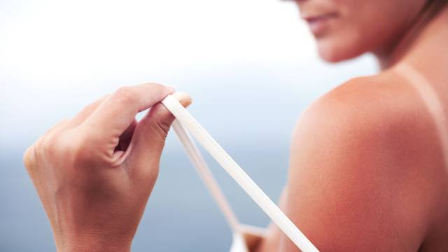 Liječnici otkrivaju: Kako ublažiti opekline od sunca i vrijedi li krema za sunčanje od lani?