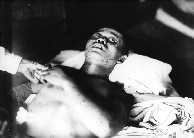 A soldier who was exposed to the atomic bombing of Hiroshima lies on a cot at the Ujina Branch of the Hiroshima First Army Hospital in Hiroshima prefecture