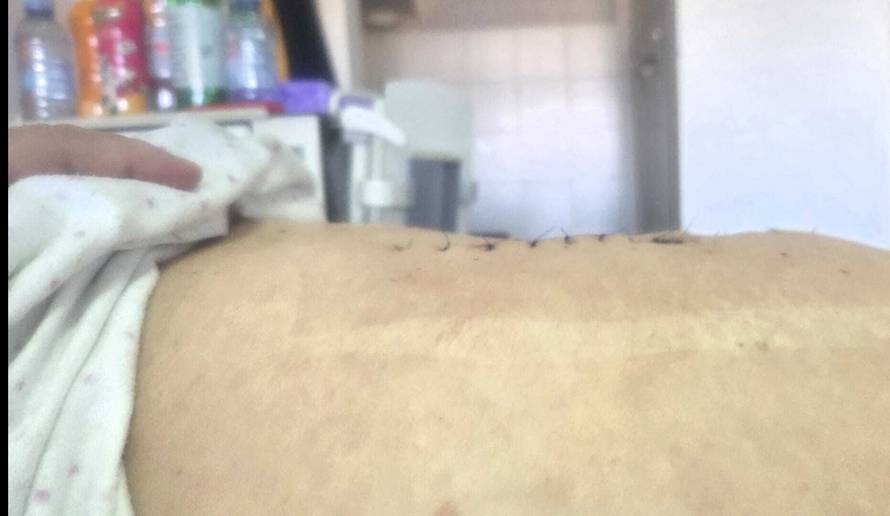 Dr. Milinović o baki Ani kojoj je izvadio tumor od 36,5 kg: 'Ovo joj je bila zadnja šansa za život'