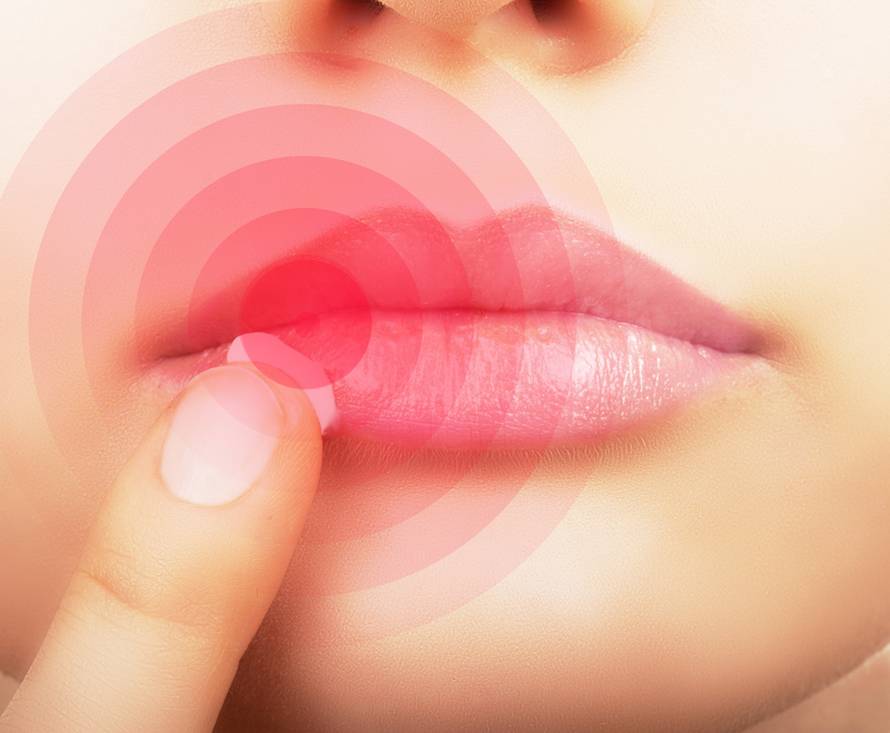 Lips affected by herpes.