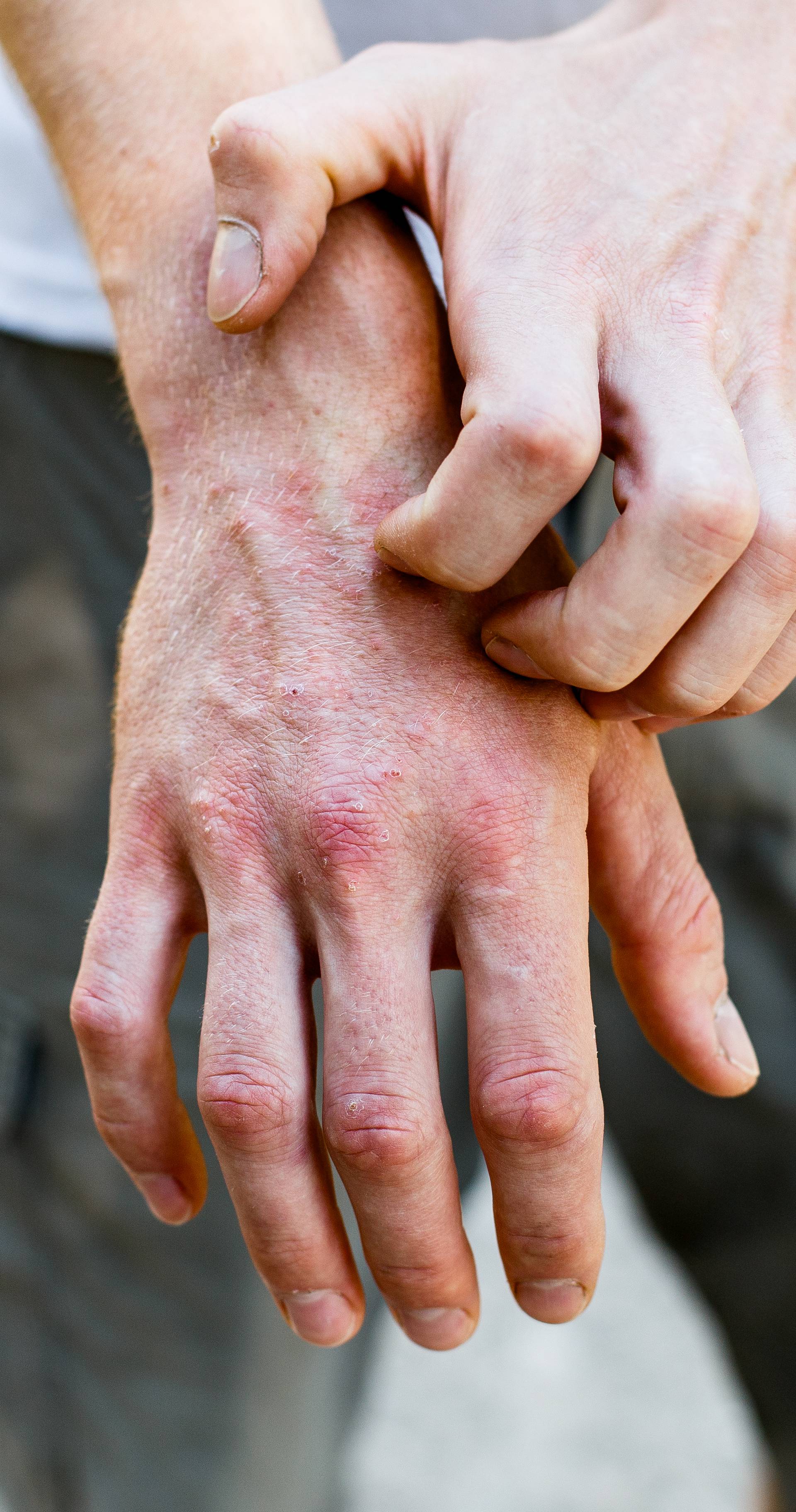 15 savjeta kako pomoći sebi i djeci s atopijskim dermatitisom