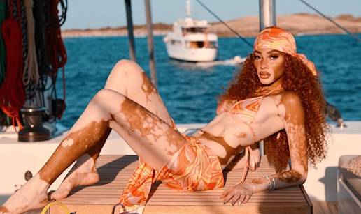 FOTO Rugali su joj se zbog bolesti, a danas je obo&zcaron;avaju zbog jedinstvenog izgleda