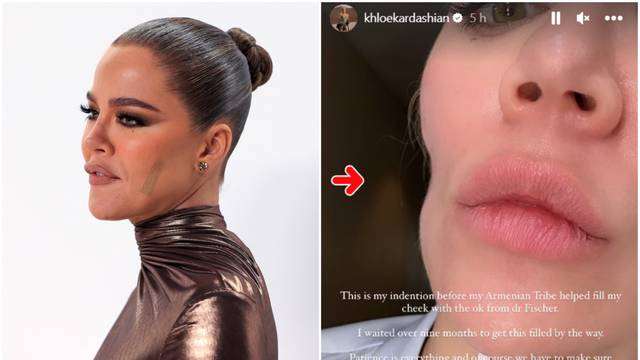 Khloe Kardashian pokazala lice nakon operacije: 'Imala sam rak kože, ostalo mi je udubljenje...'