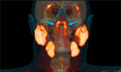 Slučajno su u glavi pacijenta s rakom otkrili sasvim novi organ