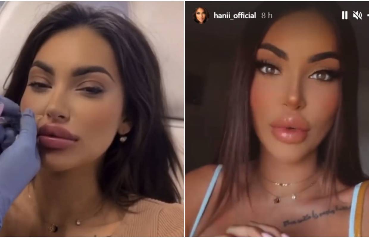 Hana objavila video na kojem stavlja filere: 'Sad su prevelike'