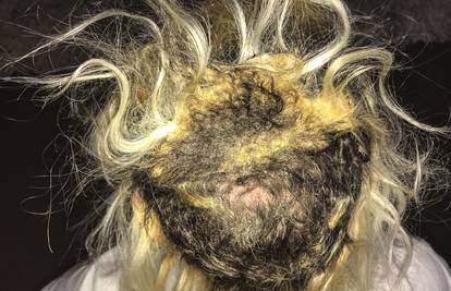 Ekstenzije iz pakla: Kosa joj je spržena i ispala - nosi periku