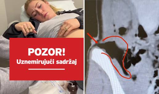 VIDEO Mikaela Shiffrin objavila grozne snimke ozljede: 'Skijaški štap umalo je probio organe'