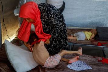 FILE PHOTO: Malnourished Palestinian children receive treatment at the IMC field hospital in Deir Al-Balah, central Gaza Strip