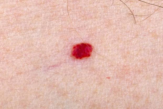 Cherry angioma on human skin