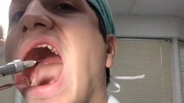 Zubar sam sebi izvadio zub