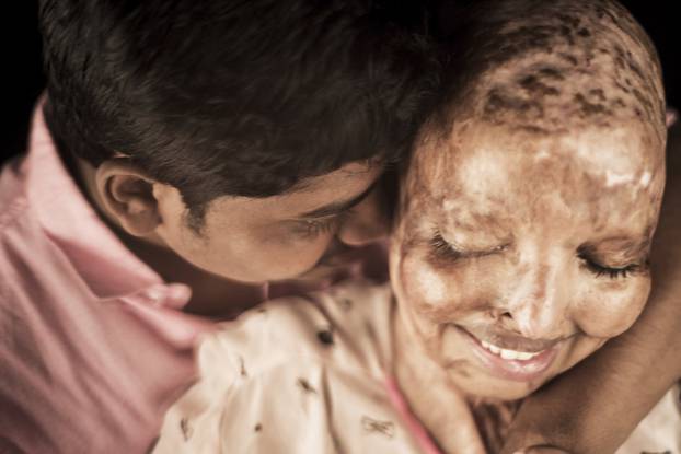 ACID ATTACK SURVIVOR FINDS LOVE