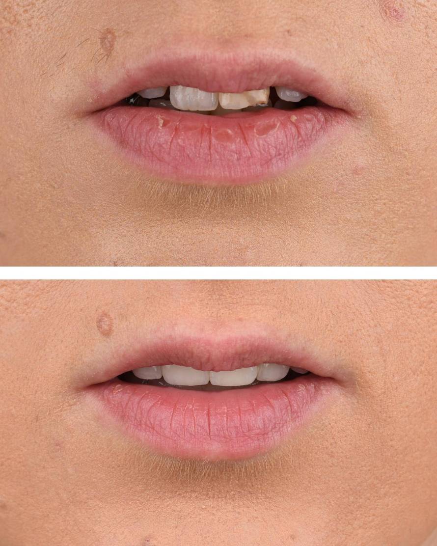 Kako izgleda proces ugradnje dentalnih ljuskica?